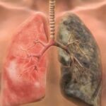 4 βιταμίνες που θεραπεύουν τους πνεύμονες μετά το κάπνισμα